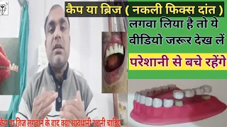 How to Care Dental Cap Bridge । नकली फिक्स दांत की देख भाल कैसे करें । How to Care Dental Prosthesis