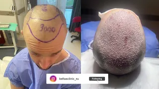 hair transplant in Bellus clinic