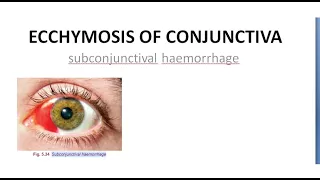 Ophthalmology Ecchymosis of Conjunctiva SubConjunctival Hemorrhage Blood red eye