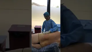 Liposuction with doc B!