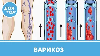 Проведение склеротерапии при варикозе. Вопросы флебологу