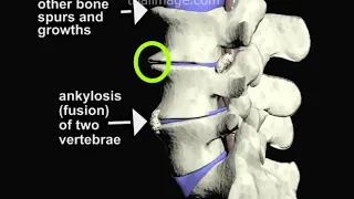 Degenerative Disc Disease of the Spine (ALIF Part 1) - Animation by Cal Shipley, M.D.