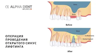 Операция проведения открытого синус лифтинга | др. Лунгу В.И. | Alpha Dent Implants