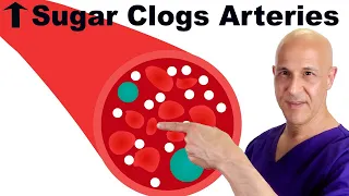 Prevent High Blood Sugar from Causing Clogged Arteries | Dr. Mandell