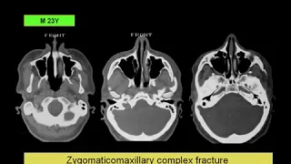 Dr Mamdouh Mahfouz Maxillo facial injuries=2