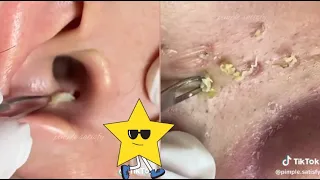 Ultimate ASMR Pimple Popping Compilation: Blackhead & Whitehead Extractions, Acne Removal
