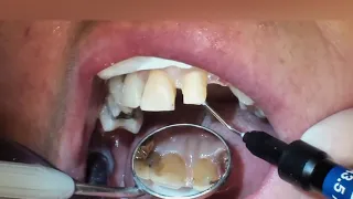 Installation of dental bridge,  one visit bridge