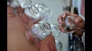 Cupping: Pain Therapy