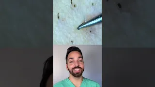 Doctor Reacts to Ingrown Hair #shorts