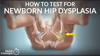 "How to Test for Newborn Hip Dysplasia" by Nina Gold for OPENPediatrics