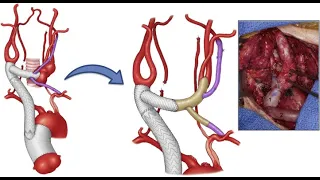 What Is Takayasu Arteritis? - Symptoms, Complications & Treatment Methods