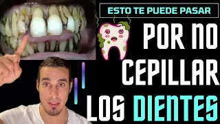 La FATAL CONSECUENCIA de no lavarse los dientes - SARRO y PERIODONTITIS