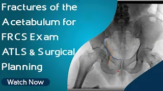 Fractures of the Acetabulum for FRCS Exam | ATLS & Surgical Planning