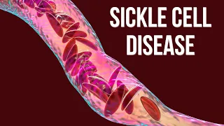Sickle Cell Disease: Causes, pathophysiology & Treatment (clinical essential)