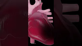 Heart Attack Explained (Animation)