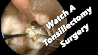 Tonsillectomy Surgery - actual footage