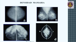Estudio de las mamas por ecografía - Dra. Gabriela Pun Loay Moscaiza