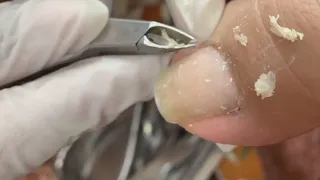 HOW TO CUT THICK TOENAILS - Toenail Cleaning Satisfying #284