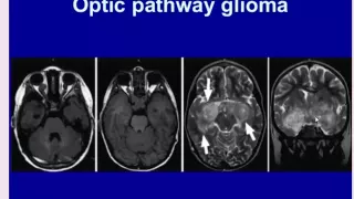 Imaging of pediatric neurocutaneous disease   Prof Dr  hassan El Kiki In Arabic