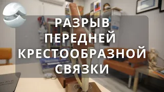 Разрыв передней крестообразной связки: нужна ли операция?