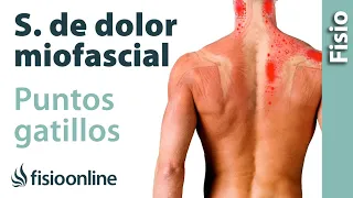 Qué son los puntos gatillo o síndrome de dolor miofascial y su tratamiento