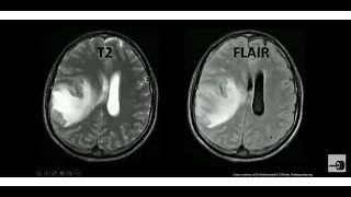 MRI Sequences (T1,T2,Flair,SWI,DWI,ADC) made easy