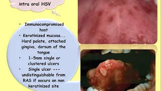 Viral infections - Herpes simplex