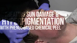 Chemical Peel for Sun Damage and Hyperpigmentation | RevePeel TCA PHENOL MIX | Dr. Jason Emer