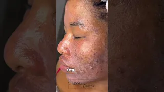 Chemical peel safe for skin of color