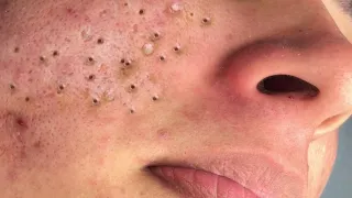 Relax everyday with Blackheads 0397