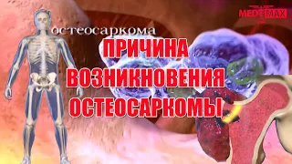 Остеосаркома. Что это за болезнь?