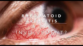 How is Rheumatoid Arthritis Affecting Your Eyes? - A Rheumatologist Review