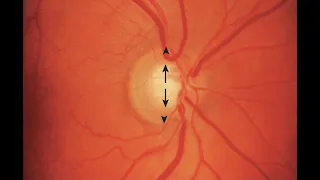 Normal Optic Disc Appearance