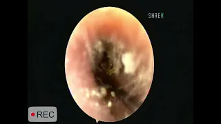 Ear wax removal: A large soft cerumen, a one-time to hook out, very cool very decompression