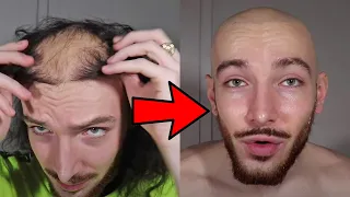 He Shaved His Transplanted Hair after 5 Years!!! Shocking Reveal!