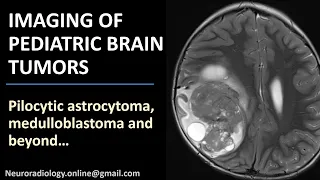 Imaging of Pediatric Brain Tumors