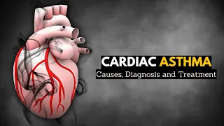 Cardiac Asthma: Causes, Signs and Symptoms, Diagnosis and Treatment