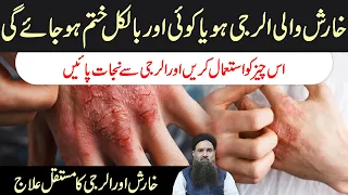 Kharish Ka ilaj | Allergy Ka ilaj | itching Ka ilaj | How to Stop Skin itching Dr Sharafat Ali 2021