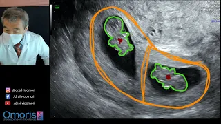 Ultrasound of TWINS! Emotion in the first ultrasound!