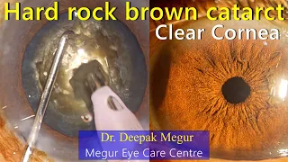 Secrets for post op  clear cornea after Phacoemulsification of  a rock Hard Cataract ..! Dr Deepak