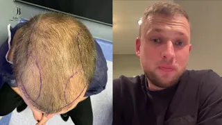 Пересадка волос до и после, начальный результат пересадки волос Дмитрия из России