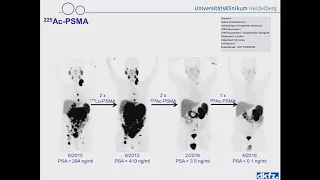 PSMA targeted radionuclide therapy - Prof. Uwe Haberkorn