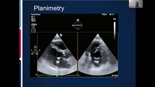 Joint Echo Conference: Mitral Stenosis