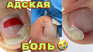 Жуткая боль 😬 Запустила себя 💅 Педикюру 3 месяца