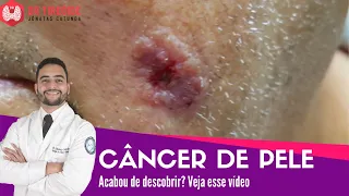 Câncer de pele - Vídeo para quem acabou de descobrir! | Dr Jônatas Catunda