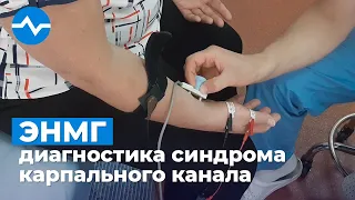 ЭНМГ диагностика синдрома карпального канала. Реальный клинический случай.