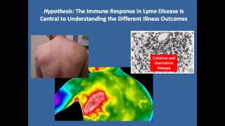 Lyme Disease and Post-Treatment Lyme Disease Syndrome by John Aucott, MD