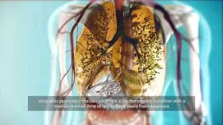 Introduction into idiopathic pulmonary fibrosis (IPF)