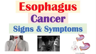 Esophageal Cancer Signs & Symptoms (& Why They Occur)