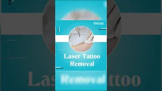 Everyone Loves Laser Tattoo Removal | Viral #shorts